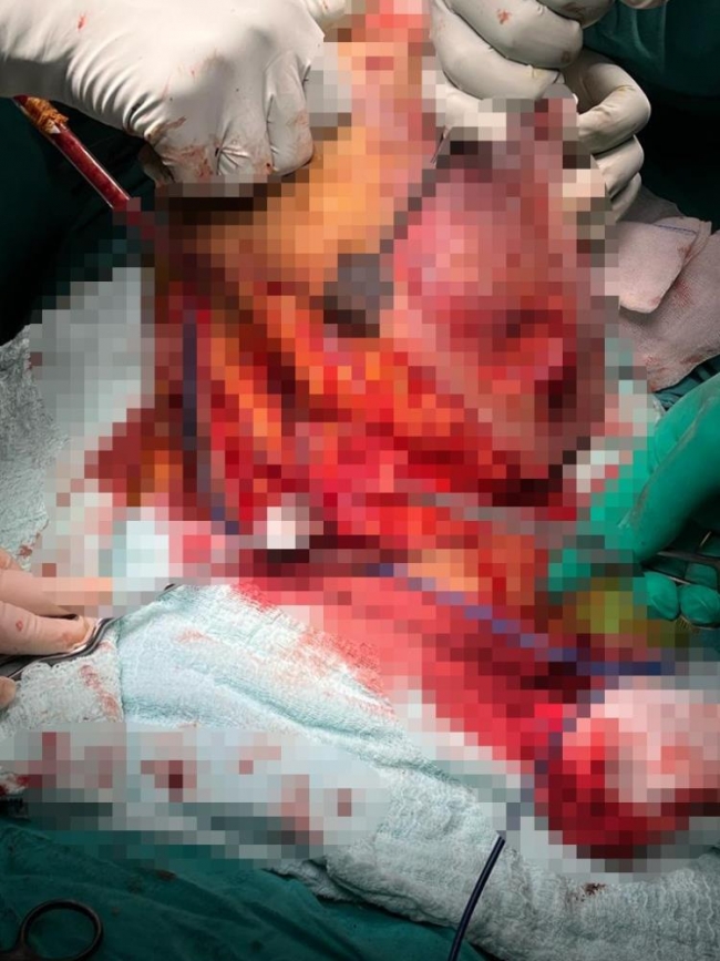 Doktorlar bile şaşkına döndü! Urfalı adamın kalçasından çıkan şoke etti