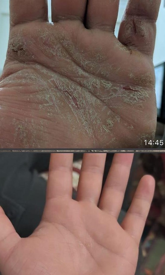  Bitkisel karşım sonucu o hastalığa çare buldu