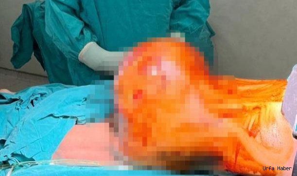 Doktorlar bile şaşkına döndü! Urfalı adamın kalçasından çıkan şoke etti