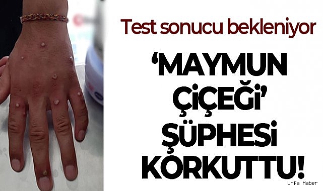 Sultangazi'de 'Maymun Çiçeği' şüphesi korkuttu