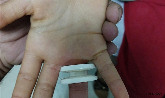 PARMAĞINA PLASTİK PARÇASI SIKIŞTI!