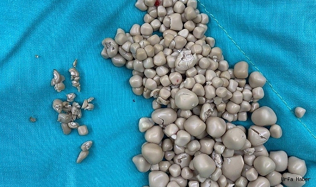 HASTANIN BÖBREKLERİNDEN 300 TAŞ ÇIKARILDI