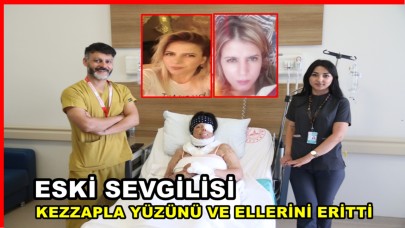 Eski Sevgilisi Kezzapla Yüzünü ve Ellerini Eritti