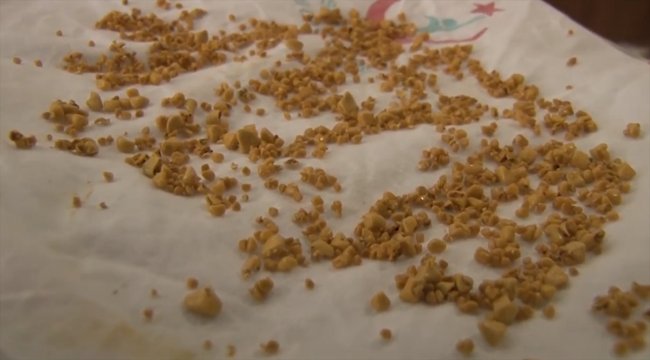 Safra kesesinden bini aşkın taş çıkarıldı