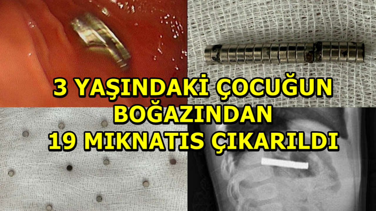 3 Yaşındaki Çocuğun Boğazından 19 Mıknatıs Çıkarıldı