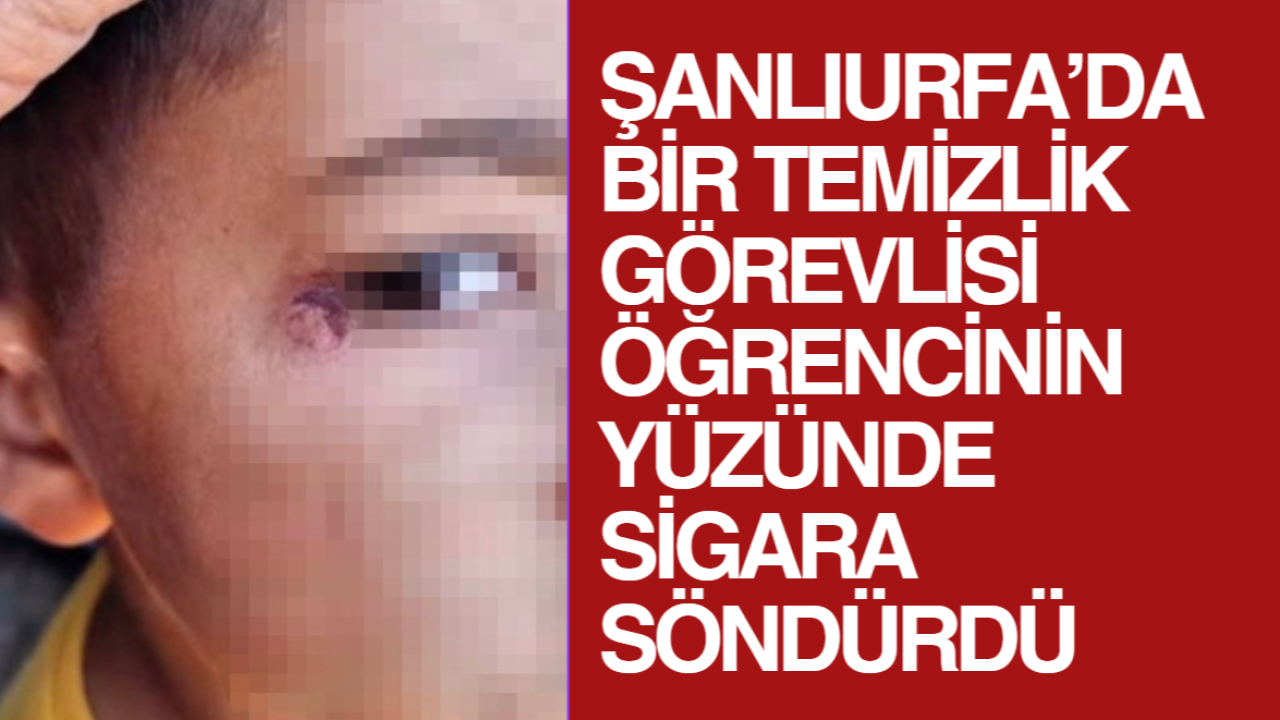 Şanlıurfa’da Öğrencinin Yüzünde Sigara Söndürüldü
