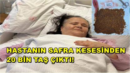 Hastanın Safra Kesesinden 20 Bin Taş Çıktı!