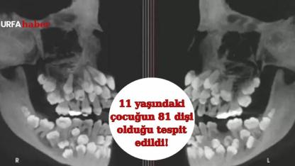 11 yaşındaki çocuğun 81 dişi olduğu tespit edildi!