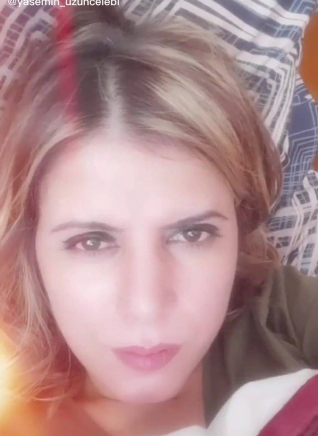 Eski Sevgilisi Kezzapla Yüzünü ve Ellerini Eritti