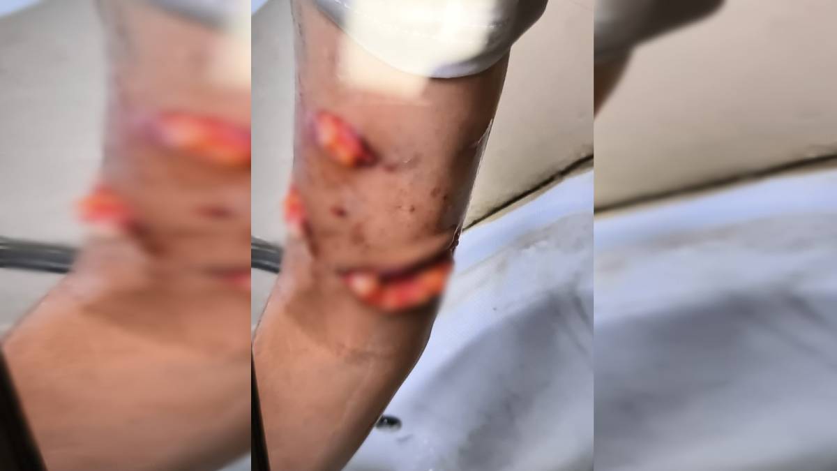 Urfa'da köpek saldırısına uğrayan Hevin için Fidan'dan tepki!