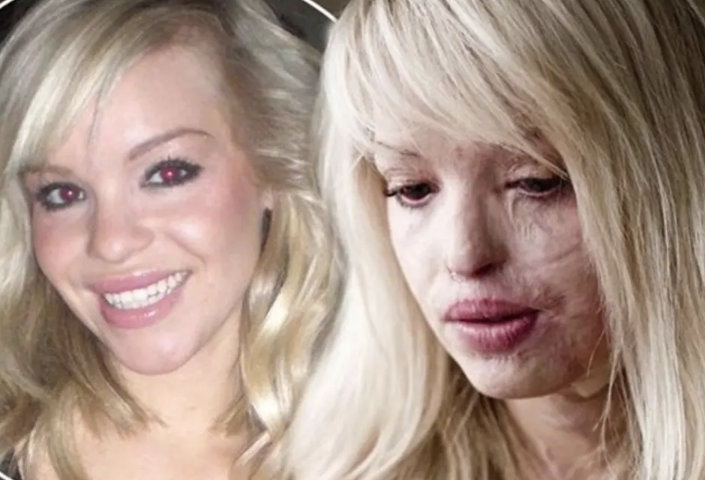 Katie Piper’ın  Süren Mücadelesi